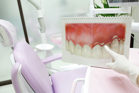 歯周病治療はなぜ必要か
