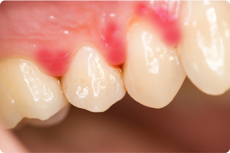 歯周病治療  十日市場ファミリー歯科